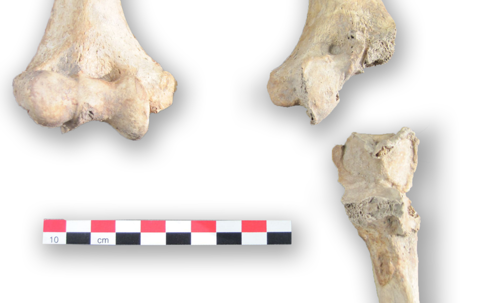 Une fracture du coude gauche provenant d’un squelette du Mont-Saint-Eloi. L’humérus montre une destruction de l’articulation et de l’arthrose qui devait limiter les mouvements du bras.